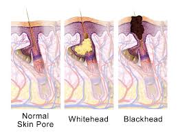 Cara yang paling mudah untuk menghilangkan komedo hitam yaitu dengan air hangat. 9 Cara Semulajadi Hilangkan Blackhead Whitehead Pada Wajah
