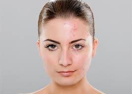 Image result for acne face
