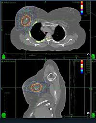 5 Questions Patients Might Be Reluctant To Ask About Radiation Therapy Cancer Ut Southwestern Medical Center