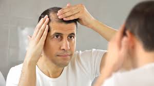 Does anyone visit doctor and get good result? Hair Loss Nyu Langone Health