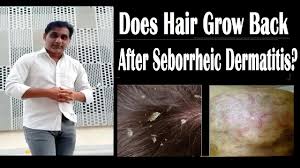 Seborrheic dermatitis is an inflammatory skin condition. Does Hair Loss From Seborrheic Dermatitis Grow Back Youtube