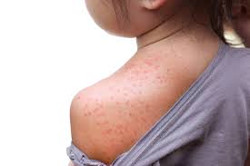 Bintik merah di badan tanpa demam. Penyebab Petechiae Apa Saja Yang Perlu Diperhatikan