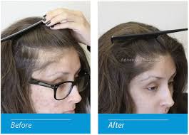 DHT Blocker with Immune Support Nutraceutical (Copy)