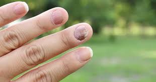 Adalah jelas bahawa semua sebab dan gejala di atas penampilan bintik hitam pada kuku akan menjadi ciri untuk ibu jari tangan atau kaki. Jangan Disepelekan Kuku Hitam Menunjukan Kondisi Kesehatan Popmama Com