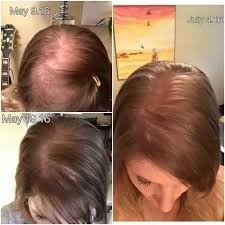 Thin hair can also be related to certain medications like thyroid replacement medications nervous to cut thin, fine hair ? What Is The Best Shampoo For Thin Thinning Hair That Won T Make Your Hair Feel Greasy Or Weighed Down Quora