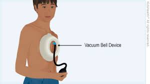 Image result for Pectus Excavatum