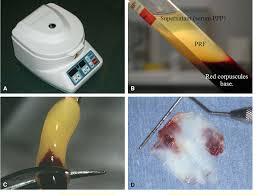 Physical register file, in cpu design. Figure 3 From Platelet Rich Fibrin Prf A Second Generation Platelet Concentrate Part I Technological Concepts And Evolution Semantic Scholar