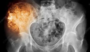 Image result for Chondrosarcoma