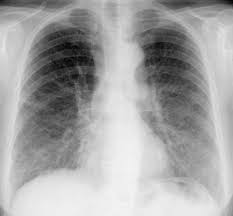 Pneumologie Unsere Krankheitsbilder Im Rontgenbild