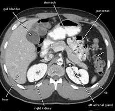 Medicare coverage includes a prescreening counseling visit with the health professional who wrote radiation exposure from ct scans in childhood and subsequent risk of leukaemia and brain tumours: Pancreatic Cancer Ct Scan Shefalitayal