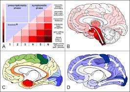 Parkinson's disease (pd) impacts people in different ways. Stages In The Development Of Parkinson S Disease Related Pathology Springerlink