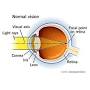 Laser eye surgery from my.clevelandclinic.org