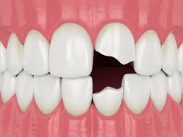 If you have a cavity, a trip to the dentist is in order. How To Fix A Chipped Tooth At Home Temporarily Newmouth