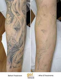 This Is A Portion Of A Full Sleeve We Faded The First Pass Knocked Out Nearly All The Grey Was Arm Tattoo Removal Picosure Tattoo Removal Tattoo Removal Cost