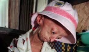 Image result for progeria case in bihar