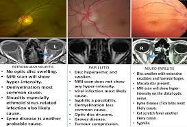 Eye Care In The Community Part 10 Optic Neuritis Optician