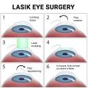 LASIK Eye Surgery in NYC - Vitreous Retina Macula Consultants of ...
