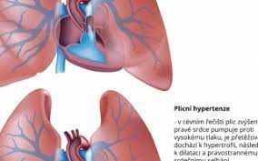 Plicní hypertenze je definována jako abnormální vzestup krevního tlaku v plicních cévách. Plicni Hypertenze Priznaky A Lecba