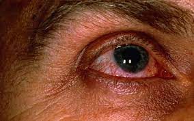 Bei roten augen oder dem roten auge handelt es sich um eine erkrankung, bei der das weiße des auges (die sklera) gerötet oder blutunterlaufen ist. Rote Augen Gerotete Augen Ursachen Therapie Onmeda De
