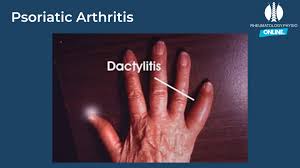 Image result for Dactylitis
