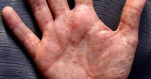 It's itchy even when the rash isn't there, also my joints on my hands and feet were. Small Intensely Itchy Water Blisters On Hands And Feet Are Due To Dyshidrotic Eczema They May Worsen To Cause C Water Blister Eczema Pictures Eczema Treatment