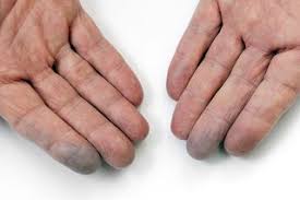 Located in orange county, san diego and los angeles. Raynaud S Nhs