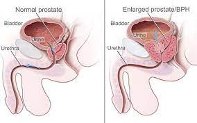 Iata ce inseamna adenom de prostata, care sunt. Cancer La Prostata Cauze Simptome Diagnostic Tratament