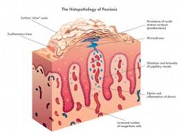 Psoriasi Sintomi Cause Tutti I Rimedi Cure Naturali It