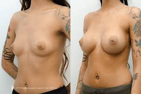 Breast Augmentation - 77P Gallery : 77P Gallery