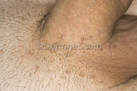 Most men who get hpv never develop symptoms and the infection usually goes away completely by itself. I Caught Genital Warts How Is This Gonna Affect My Future Relationahips Page 2 Bluelight Org