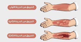كيفية علاج الحروق من الدرجة الثانية