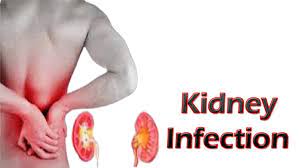 Kidney Infection - Signs, Symptoms, Causes, Treatment, Home Remedies