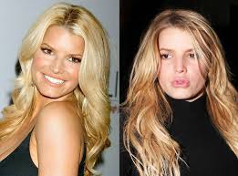 Typically, the doctor makes one long incision in your hip to remove the bone and. Photos From Celebrities Who Regret Having Plastic Surgery E Online