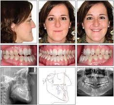 Maybe you would like to learn more about one of these? Nonsurgical Correction Of Severe Skeletal Class Iii Malocclusion Jco Online Journal Of Clinical Orthodontics