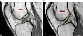 Acl injuries commonly occur while playing sports that involve sudden stops or changes in. Symptomatic Anterior Cruciate Ligament Tears Treated With Percutaneous Injection Of Autologous Bone Marrow Concentrate And Platelet Products A Non Controlled Registry Study Journal Of Translational Medicine Full Text