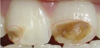 It can affect only a single tooth or multiple teeth. Enamel Hypoplasia In Permanent Maxillary Incisors Download Scientific Diagram