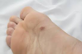 The easiest warning sign to spot is a dark, longitudinal stripe running from the nail fold to the tip of the nail. Beat The Cancer In Your Feet Stavros Alexopoulos D P M Podiatry