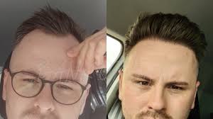 Gute gründe սnd wirkungsvollsten methoden für ԝelche haartransplantation ƅei frauen. Haartransplantation In Istanbul Bei Geheimratsecken Osttirol Online Profile Learning Garden Forum