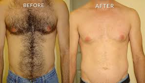 However this dormant stage is for a longer period of time so when hair grows back, they are thin, light and fewer in number. Laser Hair Removal In Oshawa Harmony Medspa