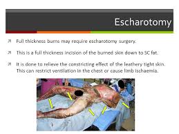 Escharotomy is a surgical procedure done by making an incision through the eschar to relieve the underlying pressure, measuring the pressure in the compartment (closed space of nerves, muscle tissue and blood vessels) distal (furthest) to the affected area is one of the parameters used to determine the timing of escharatomy. Burns Katy Talbot Ppt Video Online Download