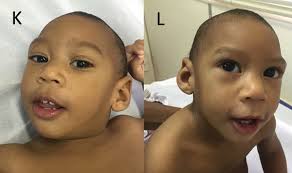 Check with your child's doctor if your child has any of the following: Microcephaly Found In Babies Of Zika Infected Mothers Months After Birth The New York Times