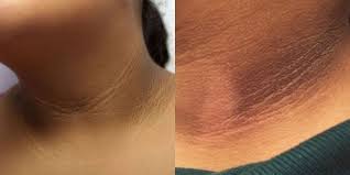 5 cara efektif hilangkan tumpukan daki di tubuh. Ramai Salah Faham Hitam Celah Badan Sebenarnya Daki Dr Tampil Beri Penjelasan Dan Cara Rawatan