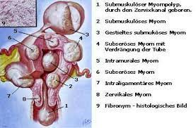 Laparoskopische Myomoperation Kantonsspital Baden Ksb