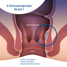 Hamorrhoiden Haufige Symptome Stadien Netdoktor At
