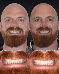 No Turkey teeth required!” 🦷 Dr Kiki Norman shares why she loves minimally  invasive smile makeovers with Invisalign and composite bonding,  transforming smiles in as little as a week without drilling teeth.