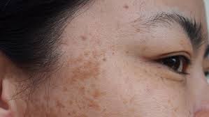 Bronzlasmak Cildi Nasil Etkiler Sinifer