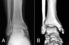 Broken ankles are painful and temporarily disabling. Proximal Avulsion Rupture Of The Flexor Digitorum Longus Tendon Associated With A Medial Malleolus Ankle Fracture Bmj Case Reports