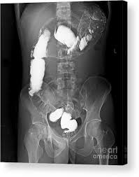 Image result for Intestinal Malrotation