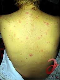 Gepatit S Vse O Zabolevanii Prostymi Slovami