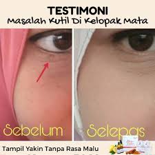 Cara hilangkan biji kolesterol pada wajah tips flawless dan gojes sekelip mata klik sini zafeshasimply.com atau wasap jer. Ketuat Bawah Mata